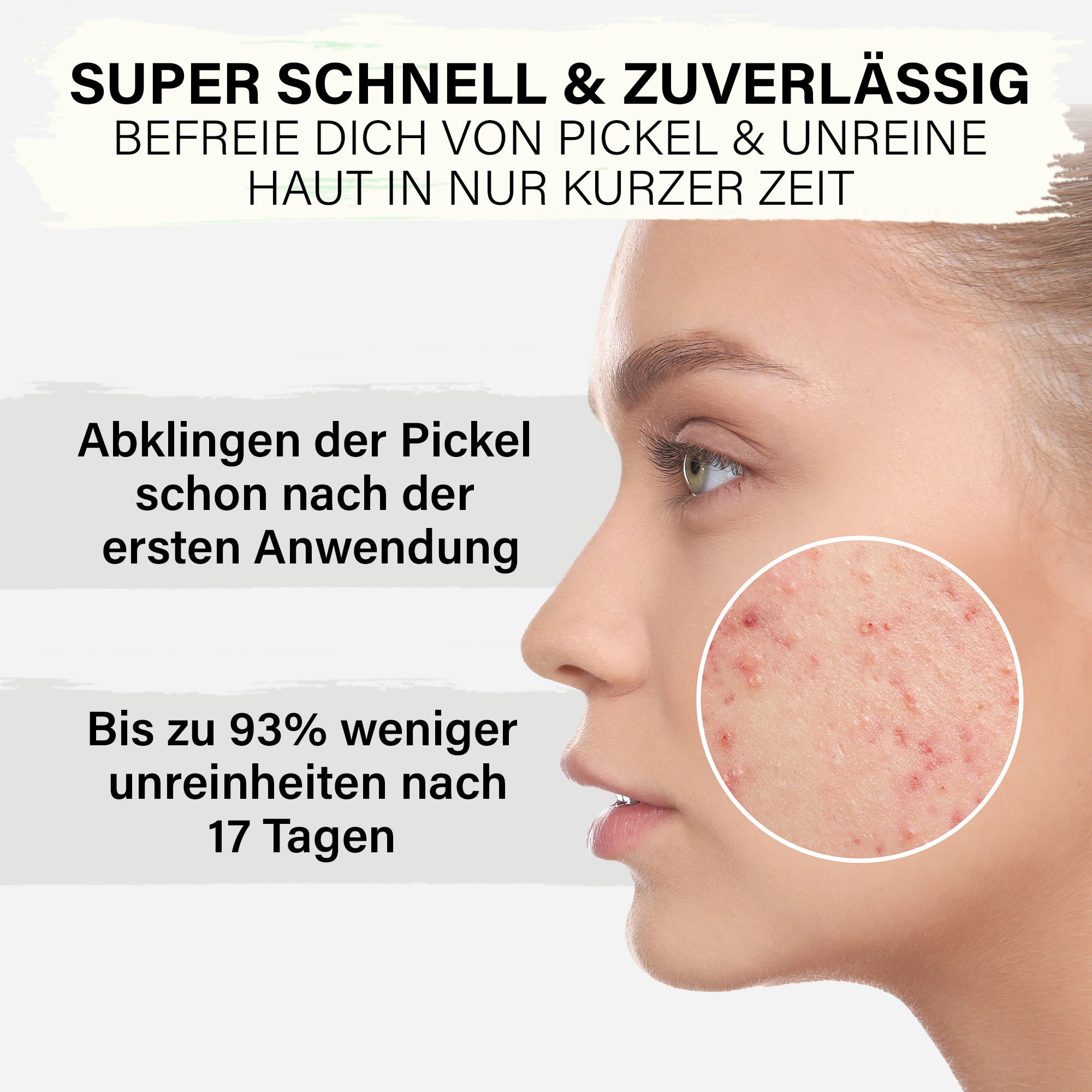 Zinksalbe mit Teebaumöl- gegen Pickel & zu Akne neigender Haut- 50 ml