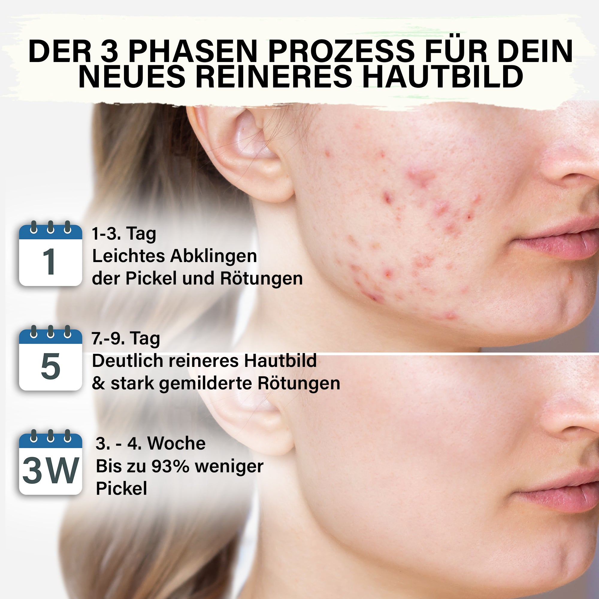 Zinksalbe mit Teebaumöl- gegen Pickel & zu Akne neigender Haut- 50 ml